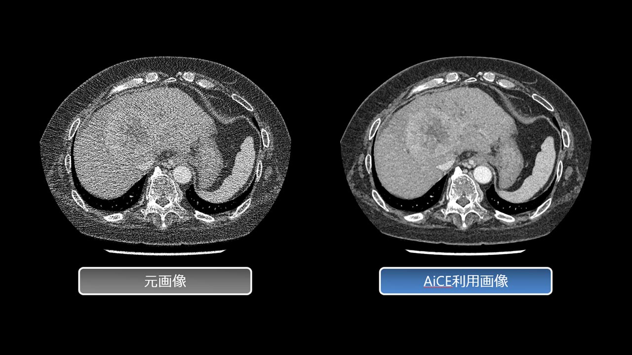 ディープラーニングを活用してCT画像のノイズを除去するCT再構成技術「AiCE」を使った肝臓のCT画像（右）
