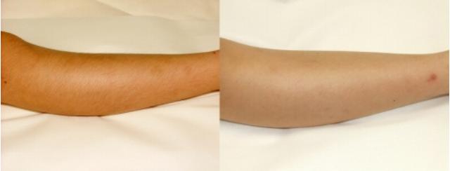 3歳からスタート キッズ脱毛 が増える理由と親心 日経クロストレンド 3歳からスタート キッズ脱毛 が増える理由と親心 日経クロストレンド